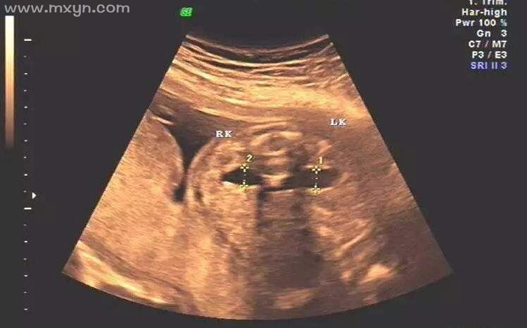 孕妇梦见胎儿检查异常